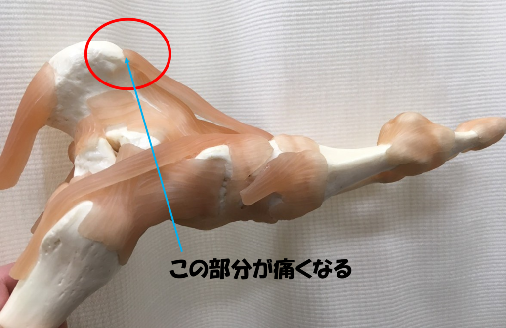 足底腱膜1